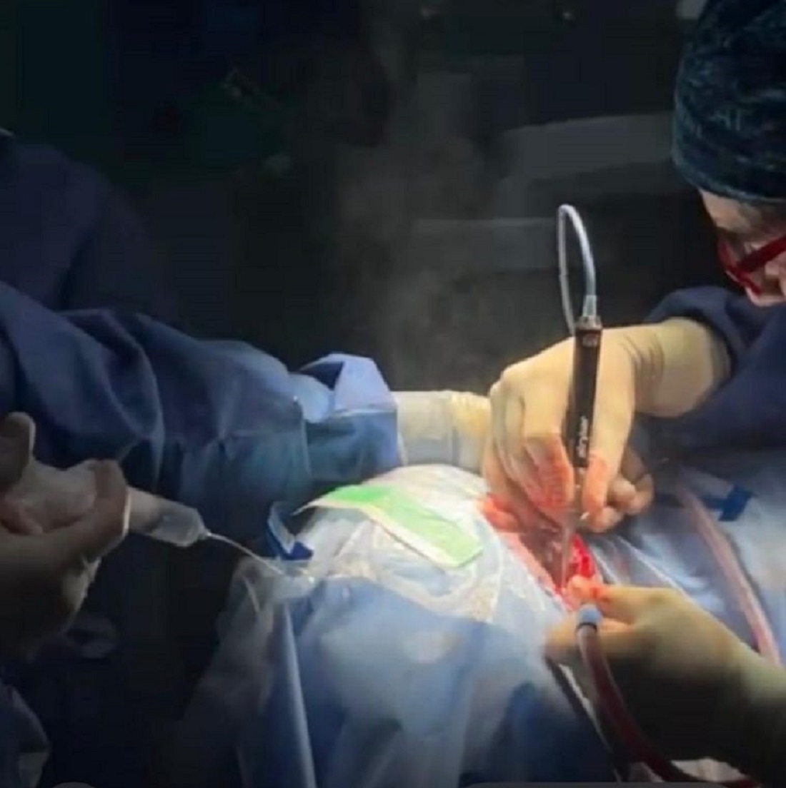 Canarie: i primi impianti osteointegrati transcutanei per migliorare la capacità uditiva
